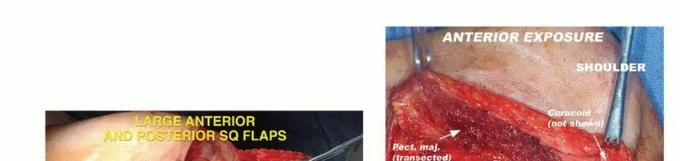 تفاصيل مرئية 15 - بتر الربع الأمامي: كل ما يجب أن تعرفه عن هذا الإجراء المعقد