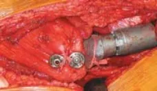 تفاصيل مرئية 37 - الخلاص من آلام سرطان العظام: استبدال مفصل الورك بالداني من الفخذ