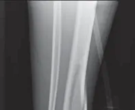 تفاصيل مرئية 21 - التثبيت الخارجي للقصبة: هكذا يتم وضع مسمارين لكسور معقدة