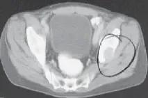 تفاصيل مرئية 7 - الخلاص من آلام سرطان العظام: استبدال مفصل الورك بالداني من الفخذ