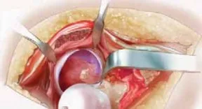 تفاصيل مرئية 20 - الفخذي المنعطف الانسي: ركيزة أمانك في خلع الورك الجراحي