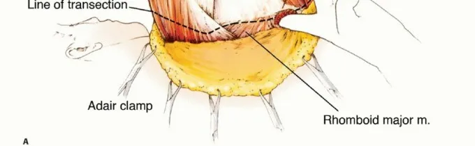 تفاصيل مرئية 23 - بتر الربع الأمامي: كل ما يجب أن تعرفه عن هذا الإجراء المعقد