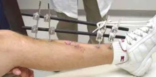 تفاصيل مرئية 7 - التثبيت الخارجي للقصبة: هكذا يتم وضع مسمارين لكسور معقدة