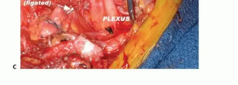 تفاصيل مرئية 40 - بتر الربع الأمامي: كل ما يجب أن تعرفه عن هذا الإجراء المعقد