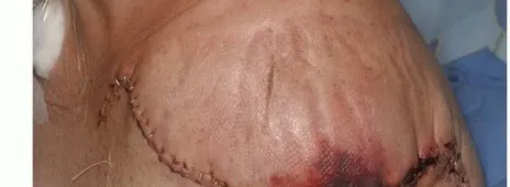 تفاصيل مرئية 49 - بتر الربع الأمامي: كل ما يجب أن تعرفه عن هذا الإجراء المعقد