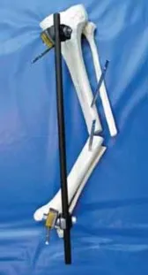 تفاصيل مرئية 34 - التثبيت الخارجي للقصبة: هكذا يتم وضع مسمارين لكسور معقدة