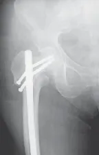 تفاصيل مرئية 18 - الخلاص من آلام سرطان العظام: استبدال مفصل الورك بالداني من الفخذ