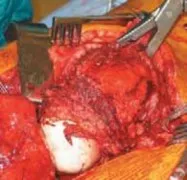 تفاصيل مرئية 34 - الخلاص من آلام سرطان العظام: استبدال مفصل الورك بالداني من الفخذ