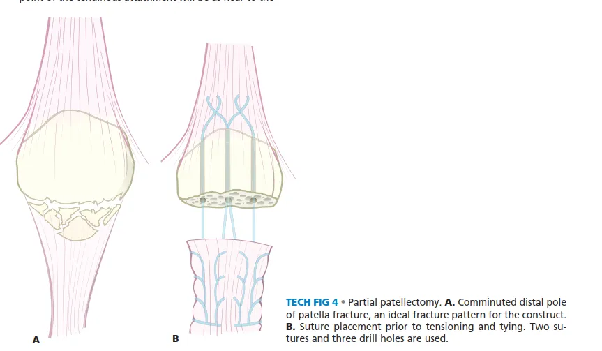 تفاصيل مرئية 7 - الرد المفتوح والتثبيت: مفتاحك لتعافي ناجح من كسور الرضفة.