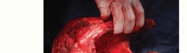 تفاصيل مرئية 31 - بتر الربع الأمامي: كل ما يجب أن تعرفه عن هذا الإجراء المعقد