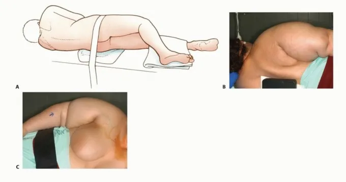 تفاصيل مرئية 10 - بتر الربع الأمامي: كل ما يجب أن تعرفه عن هذا الإجراء المعقد