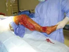 تفاصيل مرئية 24 - التثبيت الخارجي للقصبة: هكذا يتم وضع مسمارين لكسور معقدة