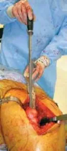 تفاصيل مرئية 31 - الخلاص من آلام سرطان العظام: استبدال مفصل الورك بالداني من الفخذ