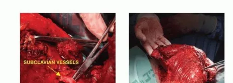 تفاصيل مرئية 37 - بتر الربع الأمامي: كل ما يجب أن تعرفه عن هذا الإجراء المعقد