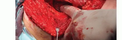 تفاصيل مرئية 25 - بتر الربع الأمامي: كل ما يجب أن تعرفه عن هذا الإجراء المعقد