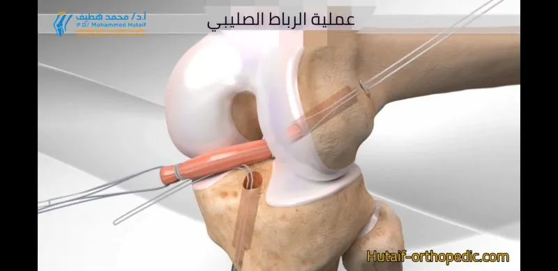 عداء يمارس تمارين الإطالة قبل الجري، يؤكد على أهمية الوقاية