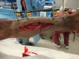 تفاصيل مرئية 46 - التثبيت الخارجي للقصبة: هكذا يتم وضع مسمارين لكسور معقدة