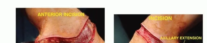 تفاصيل مرئية 13 - بتر الربع الأمامي: كل ما يجب أن تعرفه عن هذا الإجراء المعقد