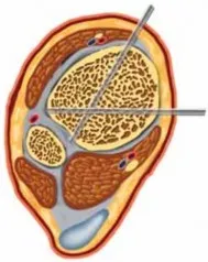تفاصيل مرئية 14 - التثبيت الخارجي للقصبة: هكذا يتم وضع مسمارين لكسور معقدة