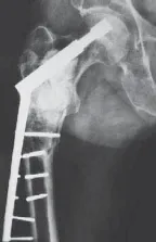 تفاصيل مرئية 16 - الخلاص من آلام سرطان العظام: استبدال مفصل الورك بالداني من الفخذ