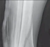 تفاصيل مرئية 19 - التثبيت الخارجي للقصبة: هكذا يتم وضع مسمارين لكسور معقدة