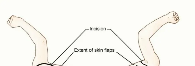 تفاصيل مرئية 11 - بتر الربع الأمامي: كل ما يجب أن تعرفه عن هذا الإجراء المعقد