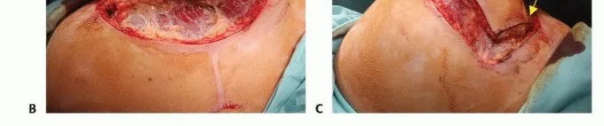 تفاصيل مرئية 14 - بتر الربع الأمامي: كل ما يجب أن تعرفه عن هذا الإجراء المعقد