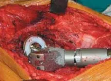 تفاصيل مرئية 36 - الخلاص من آلام سرطان العظام: استبدال مفصل الورك بالداني من الفخذ