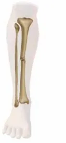 تفاصيل مرئية 47 - التثبيت الخارجي للقصبة: هكذا يتم وضع مسمارين لكسور معقدة