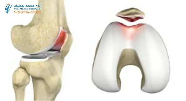 تمارين منزلية لتقوية الركبة، تظهر تمارين القرفصاء ورفع الساق