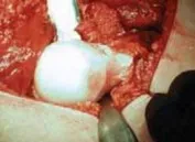 تفاصيل مرئية 21 - الفخذي المنعطف الانسي: ركيزة أمانك في خلع الورك الجراحي