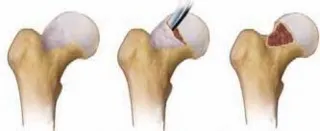 تفاصيل مرئية 30 - الفخذي المنعطف الانسي: ركيزة أمانك في خلع الورك الجراحي