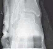 تفاصيل مرئية 20 - التثبيت الخارجي للقصبة: هكذا يتم وضع مسمارين لكسور معقدة