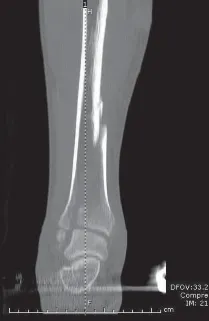 تفاصيل مرئية 23 - التثبيت الخارجي للقصبة: هكذا يتم وضع مسمارين لكسور معقدة