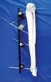 تفاصيل مرئية 36 - التثبيت الخارجي للقصبة: هكذا يتم وضع مسمارين لكسور معقدة