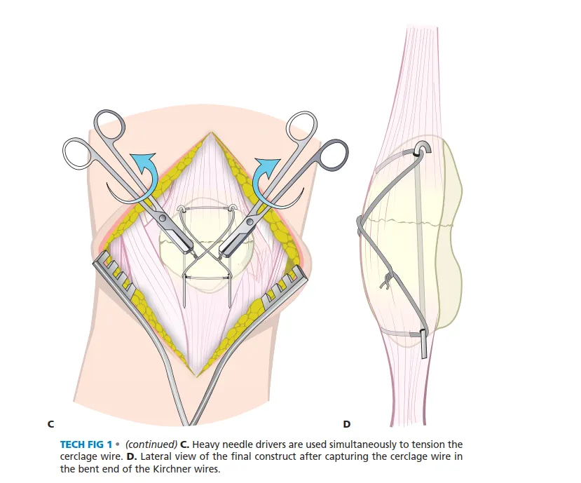 تفاصيل مرئية 5 - الرد المفتوح والتثبيت: مفتاحك لتعافي ناجح من كسور الرضفة.