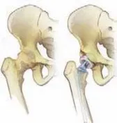 تفاصيل مرئية 12 - الخلاص من آلام سرطان العظام: استبدال مفصل الورك بالداني من الفخذ