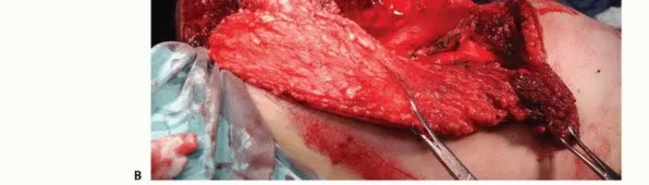 تفاصيل مرئية 32 - بتر الربع الأمامي: كل ما يجب أن تعرفه عن هذا الإجراء المعقد