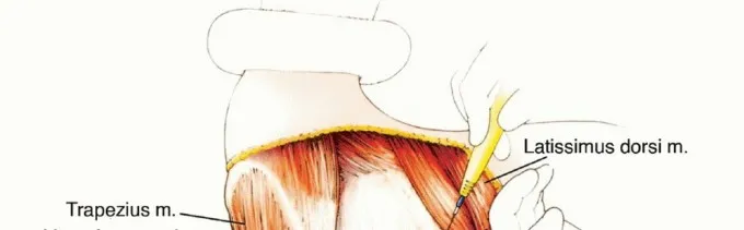 تفاصيل مرئية 22 - بتر الربع الأمامي: كل ما يجب أن تعرفه عن هذا الإجراء المعقد