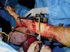 تفاصيل مرئية 18 - التثبيت الخارجي للقصبة: هكذا يتم وضع مسمارين لكسور معقدة