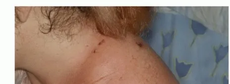 تفاصيل مرئية 48 - بتر الربع الأمامي: كل ما يجب أن تعرفه عن هذا الإجراء المعقد