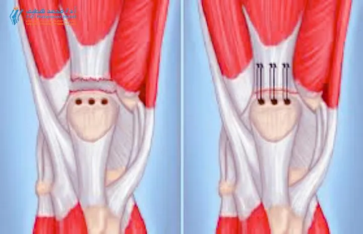 الأستاذ الدكتور محمد هطيف يشرح للمريض باستخدام جهاز كمبيوتر يوضح تقنية التشخيص الحديثة