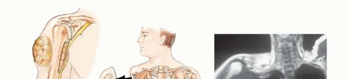 تفاصيل مرئية 4 - بتر الربع الأمامي: كل ما يجب أن تعرفه عن هذا الإجراء المعقد