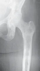 تفاصيل مرئية 20 - الخلاص من آلام سرطان العظام: استبدال مفصل الورك بالداني من الفخذ