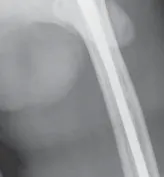 تفاصيل مرئية 6 - الخلاص من آلام سرطان العظام: استبدال مفصل الورك بالداني من الفخذ