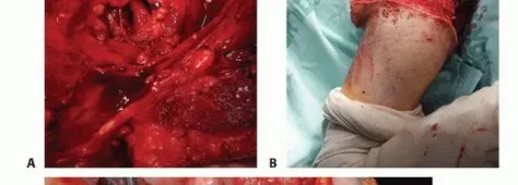 تفاصيل مرئية 38 - بتر الربع الأمامي: كل ما يجب أن تعرفه عن هذا الإجراء المعقد