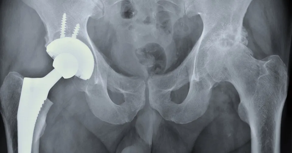 مفصل ورك مثبت بالأسمنت