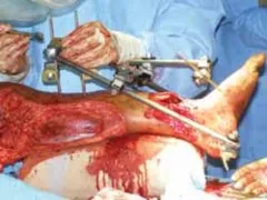 تفاصيل مرئية 25 - التثبيت الخارجي للقصبة: هكذا يتم وضع مسمارين لكسور معقدة