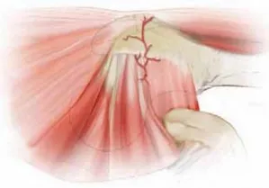 تفاصيل مرئية 11 - الفخذي المنعطف الانسي: ركيزة أمانك في خلع الورك الجراحي