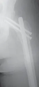 تفاصيل مرئية 22 - الخلاص من آلام سرطان العظام: استبدال مفصل الورك بالداني من الفخذ